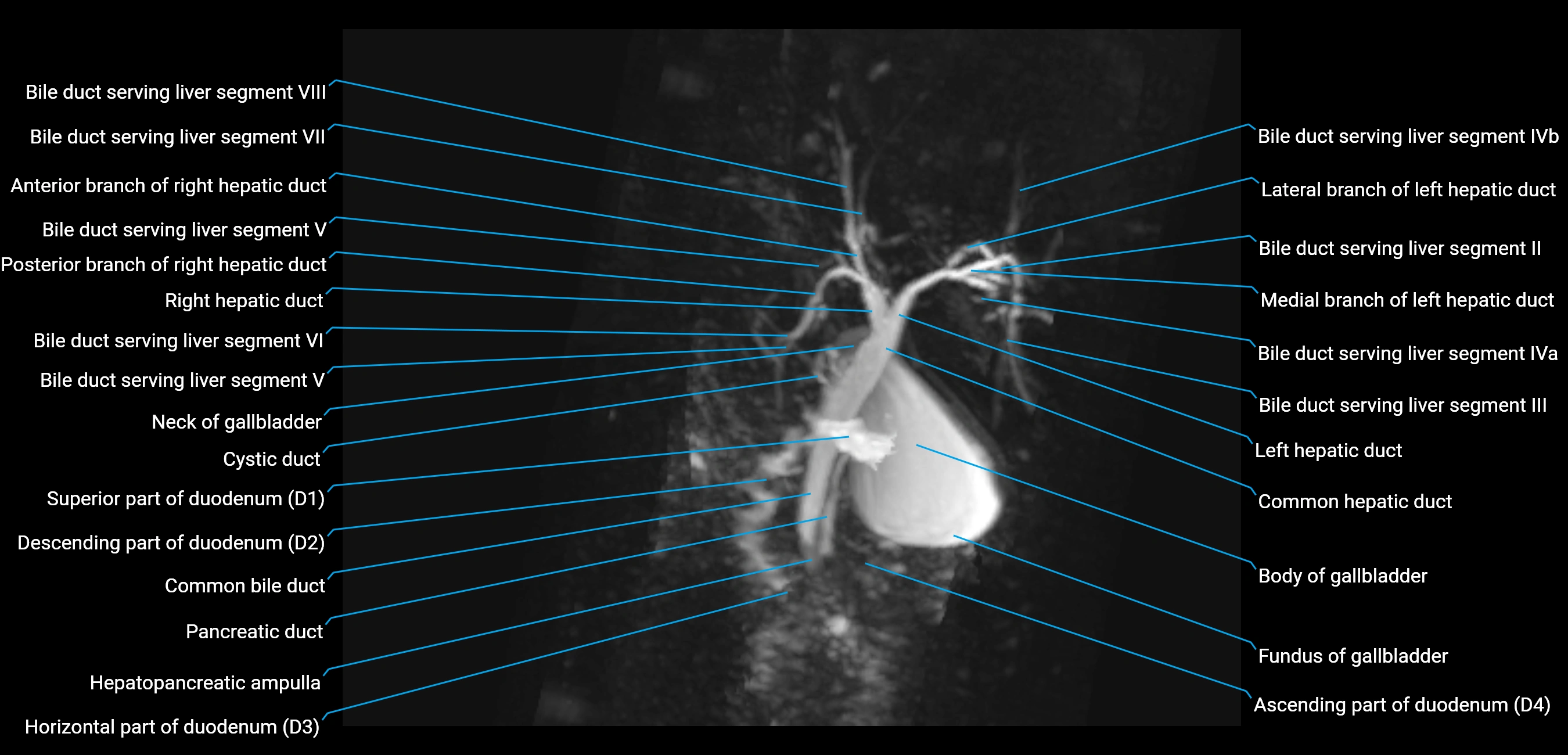 MRCP MIP MRI  anatomy labelled image-img-01003-00020.webp